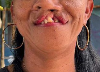 Lei que obriga cirurgia de lábio leporino é sancionada no Sistema Único de Saúde (SUS)