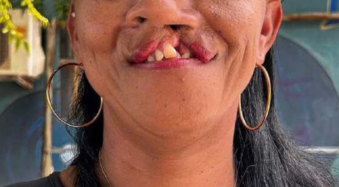 Lei que obriga cirurgia de lábio leporino é sancionada no Sistema Único de Saúde (SUS)