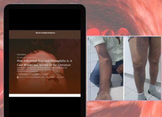 HU-Univasf diagnostica caso raro de hemofilia adquirida: relato foi publicado em revista científica internacional