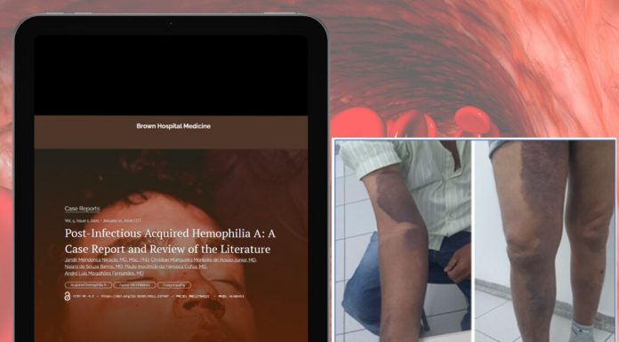 HU-Univasf diagnostica caso raro de hemofilia adquirida: relato foi publicado em revista científica internacional